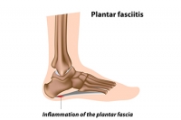 Plantar Fasciitis Is a Common Type of Heel Pain