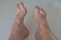 Problems and Treatment of High Foot Arches